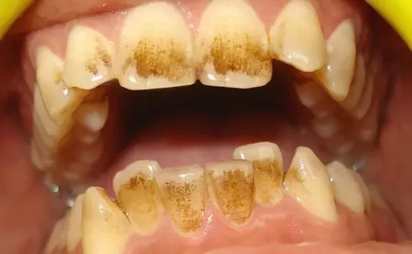 Does Drinking Tea Yellow Teeth? How to Prevent Stains from Tea